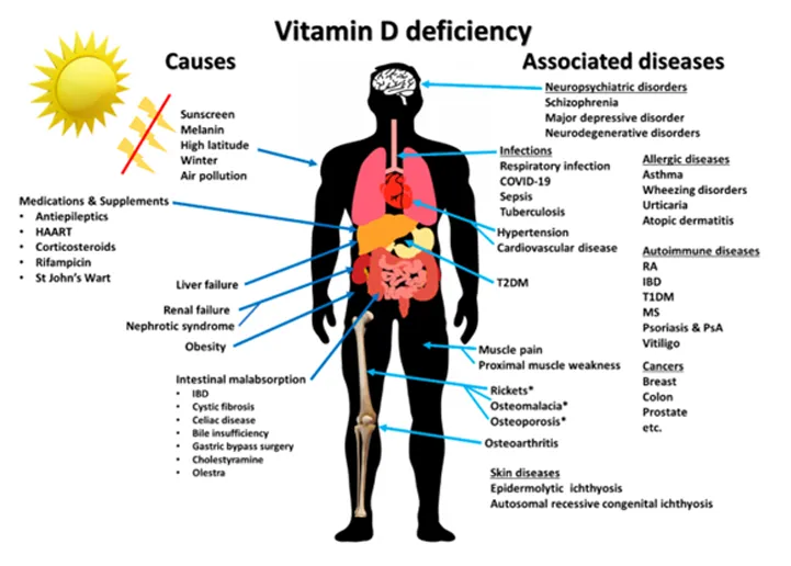 Vitamin D deficiency